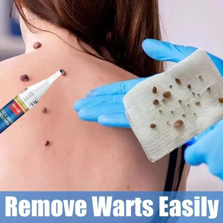 Tahi Lalat, Kutil, Kolesterol & Milia Seed Remover Buang Spots