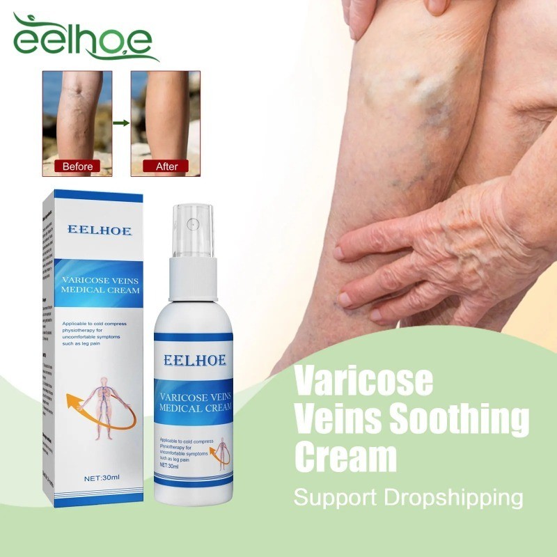Varicose Veins Relief Spray Eliminate Vasculitis Phlebitis Angiitis Relieve Spider Vein Pain Swell Earthworm Leg Treatment Spray