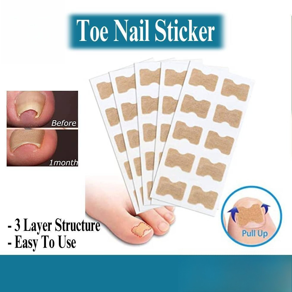10 PCS AMC Ingrown Toenail Correction Stickers, Elastic Patch Curved Toenails Brace Stickers Nail Groove Correct CurL