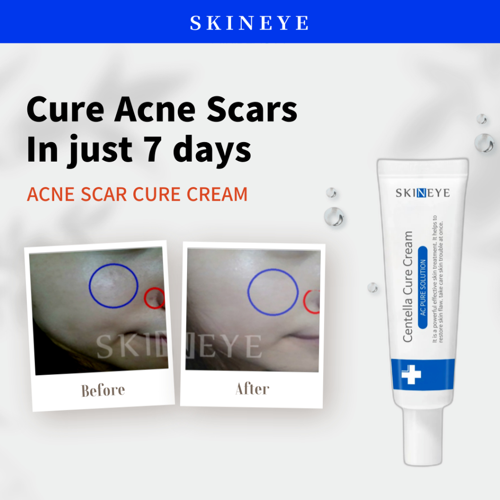 [SKINEYE] AC Pure Centella Cure Cream - 20ml, Korean Pimple Acne Scar Skincare Treatment