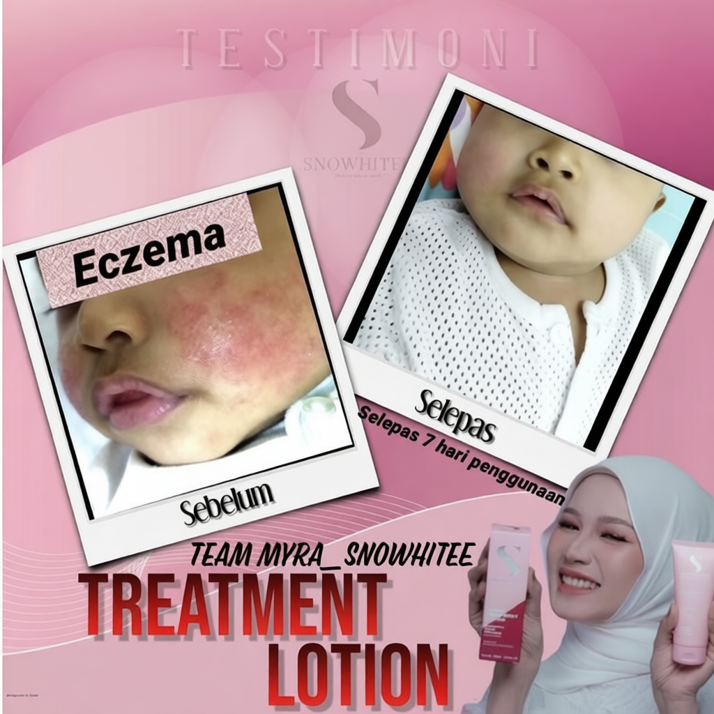 Snowy Treatment Lotion original HQ susu unta merawat eczema, krim gatal kulit, psoriasis, rashes