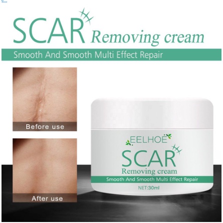 cesarean mark removal cream
